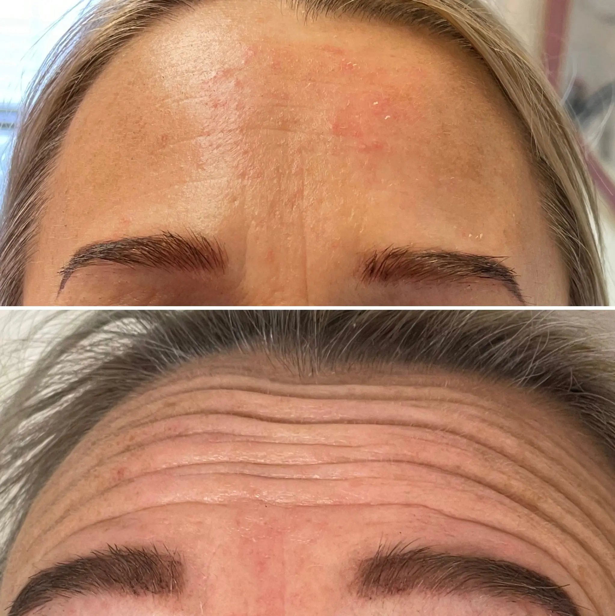 Lip filler service from Lashes Brows and Aesthetics